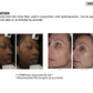 Super Brightening Pads Prescription-Strength With 2% Hydroquinone